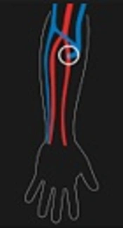 The Effect of Acupressure at the Point of Hugo on Pain Severity of Needle Insertion in Arteriovenous Fistulas in Hemodialysis Patients